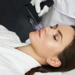 Microneedling Treatment