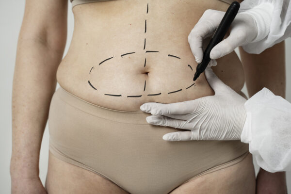 Markings on woman's belly for procedure