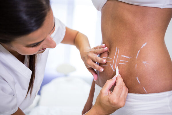 Body marked for cosmetic surgery procedures.
