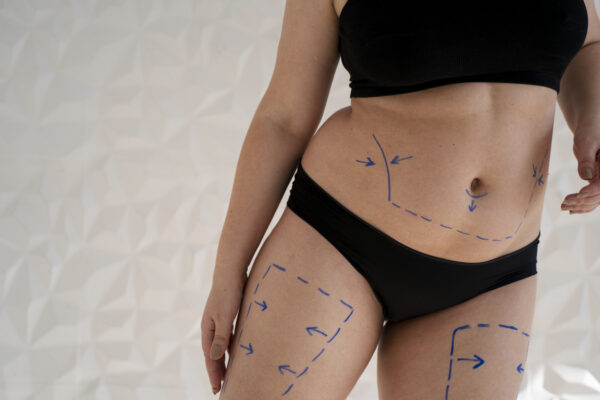 Body marked for cosmetic surgery procedures.